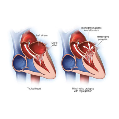 Mitral Valve Regurgitation