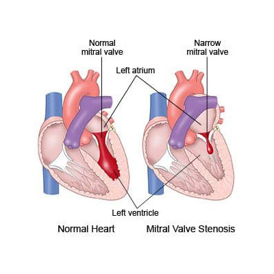 Mitral Valve Stenosis