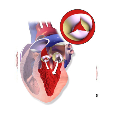 Aortic Valve Regurgitation