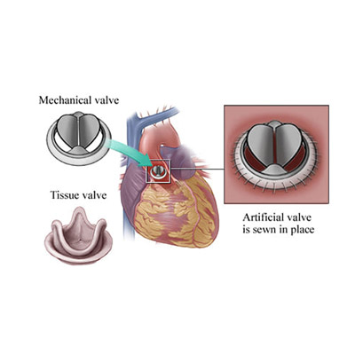 Aortic Valve Replacement