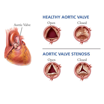 Aortic Valve Stenosis