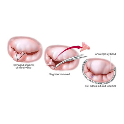 Mitral Valve Replacement