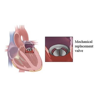 Mitral Valve Replacement